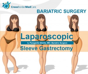 BARIATRIC SURGERY Sleeve Gastrectomy Panagiotis Glentis 2